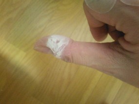 自傷性皮膚症画像：絆創膏貼り続けてたらボロボロがふやけて大変なことに